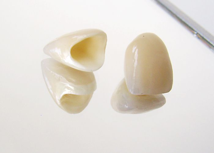 Krone Illustration einer Krone als festsitzender Zahnersatz