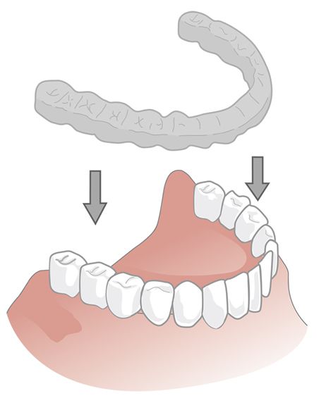 Illustration einer Knirscherschiene